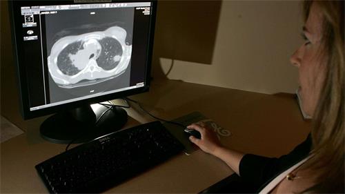 研究表明 Google AI比放射科医生更能检测到肺癌