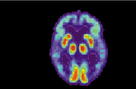 人工智能可以在诊断前六年的大脑扫描中检测出阿尔茨海默氏病